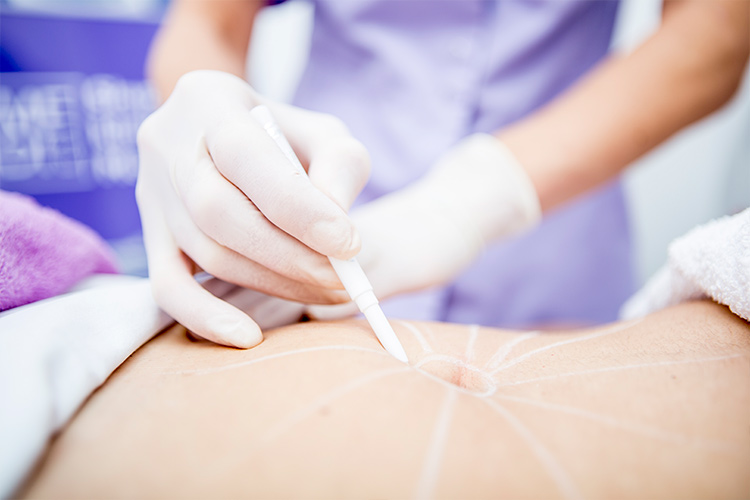 Aplicación de tratamiento estético en abdomen femenino con guantes